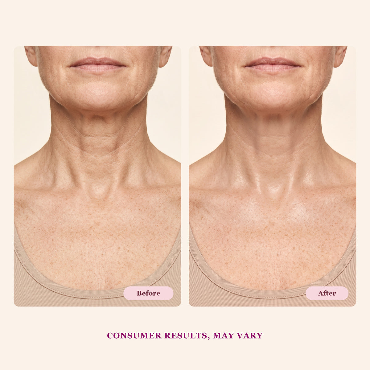 Fermeskin neck before and after illustrative visualization