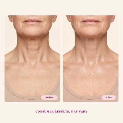 Fermeskin neck before and after illustrative visualization